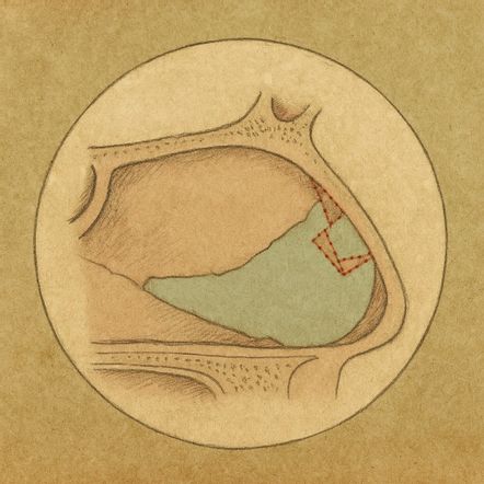 Illustration der Tetris Technik
