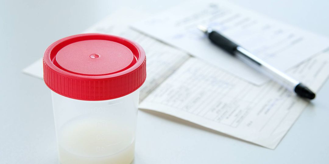 Semen analysis in a medical tank labeled in English and completed forms, on a white background. Donor sperm for artificial fertilization, infertility treatment, planning of children.